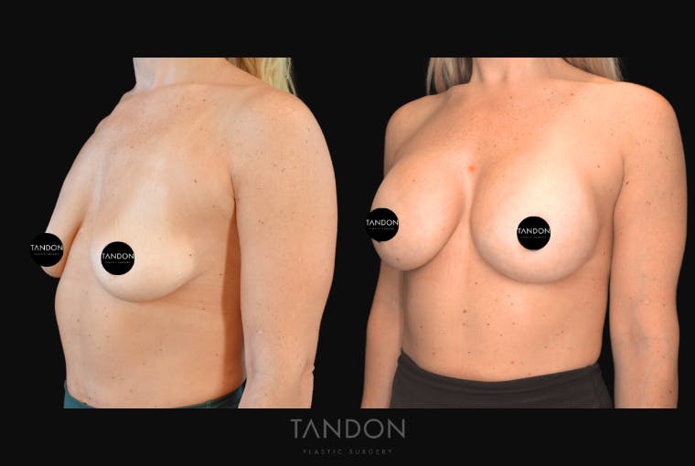 Breast Augmentation Before & After Gallery - Patient 377495 - Image 3