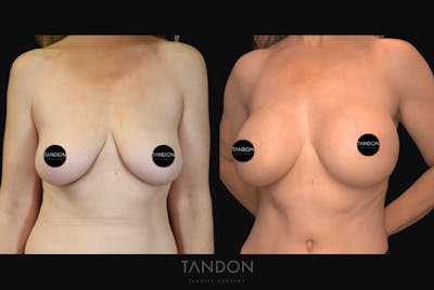 Breast Augmentation Before & After Gallery - Patient 243762 - Image 1