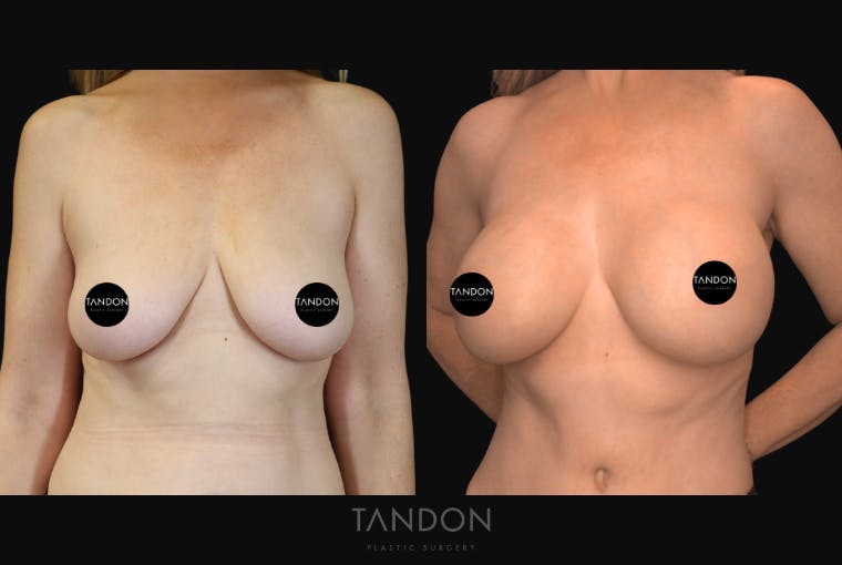 Breast Augmentation Before & After Gallery - Patient 243762 - Image 1