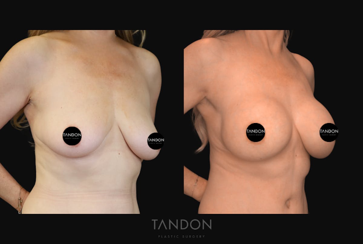Breast Augmentation  Before & After Gallery - Patient 243762 - Image 2