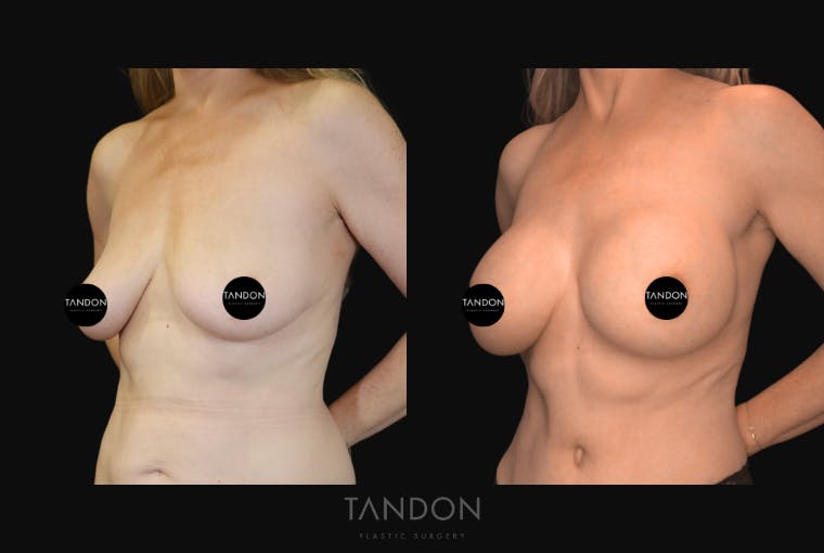 Breast Augmentation Before & After Gallery - Patient 243762 - Image 4