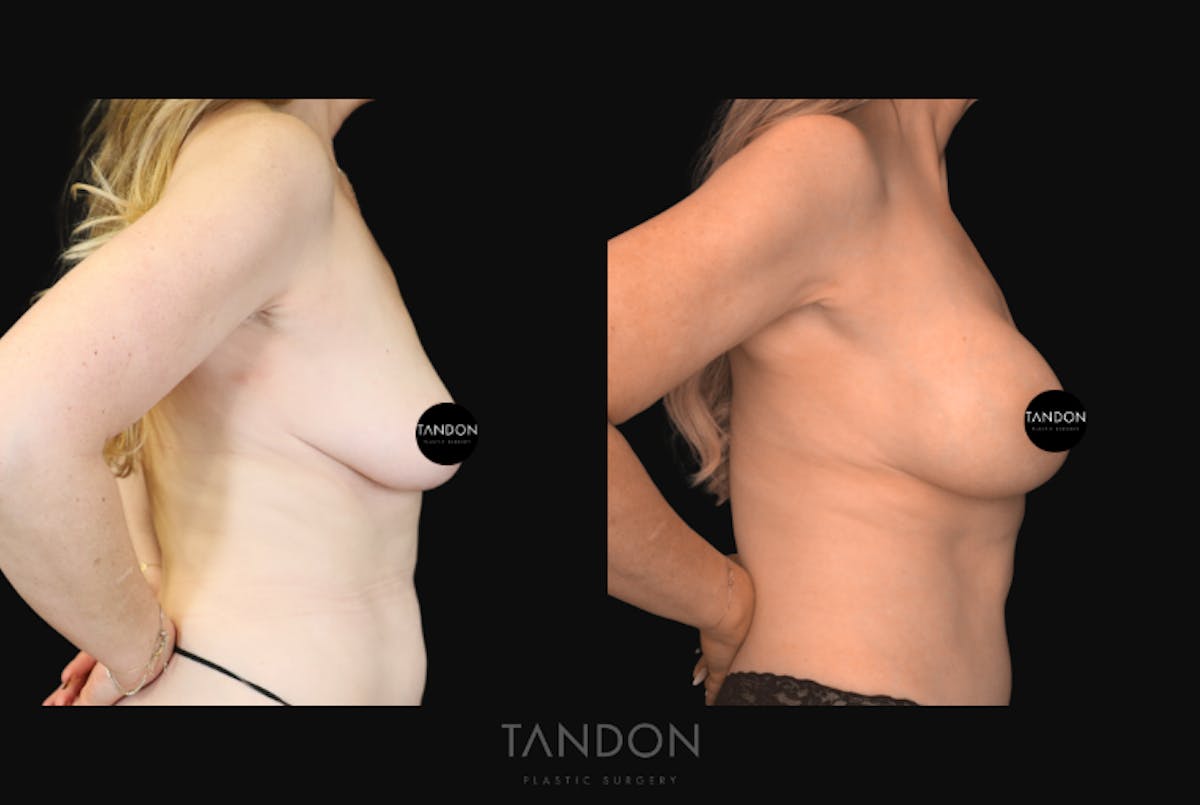 Breast Augmentation  Before & After Gallery - Patient 243762 - Image 3