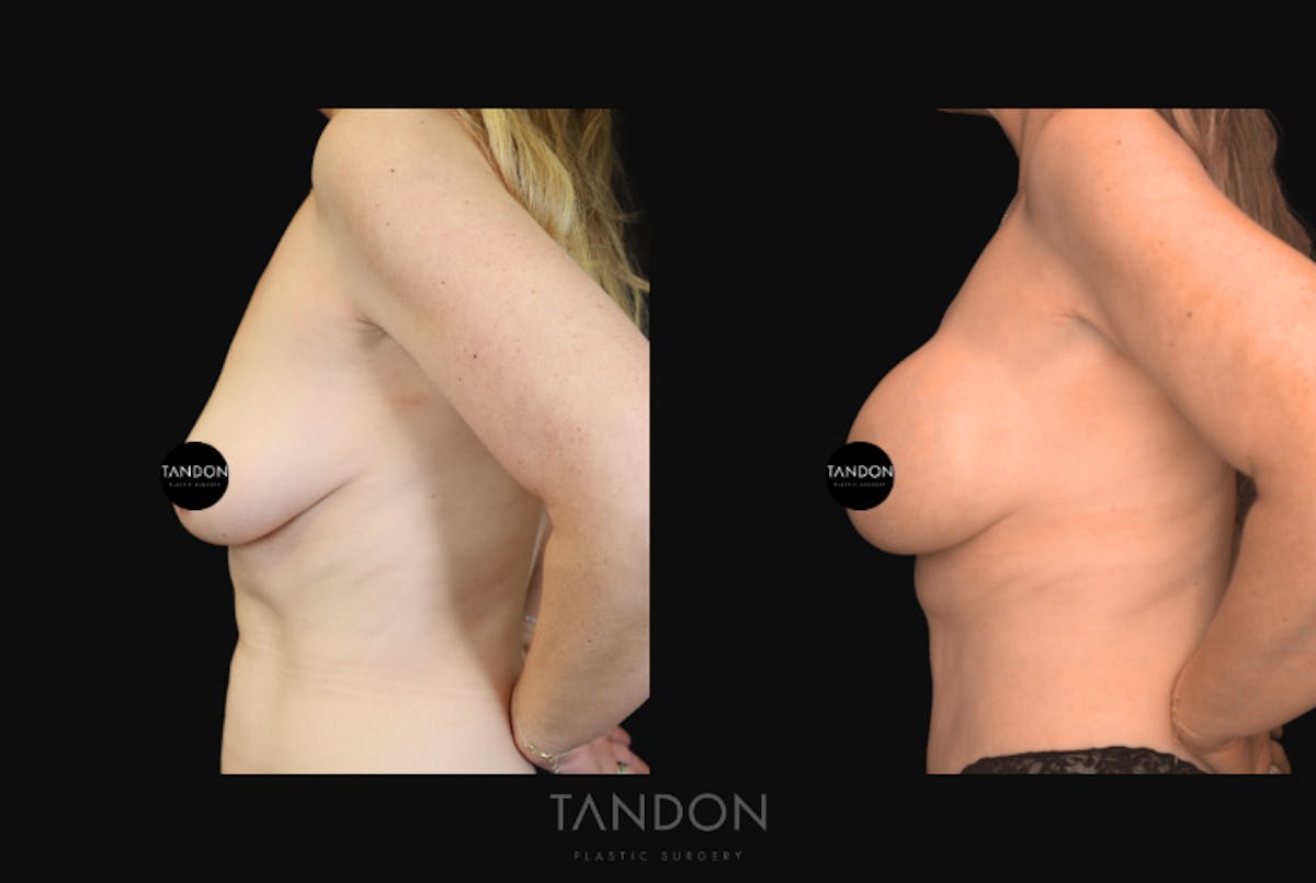 Breast Augmentation  Before & After Gallery - Patient 243762 - Image 5