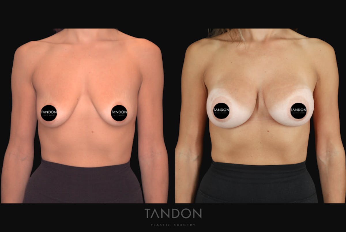 Breast Augmentation  Before & After Gallery - Patient 292318 - Image 1
