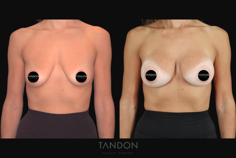 Breast Augmentation Before & After Gallery - Patient 292318 - Image 1