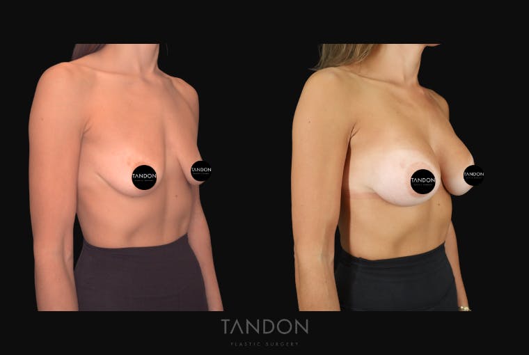 Breast Augmentation Before & After Gallery - Patient 292318 - Image 2
