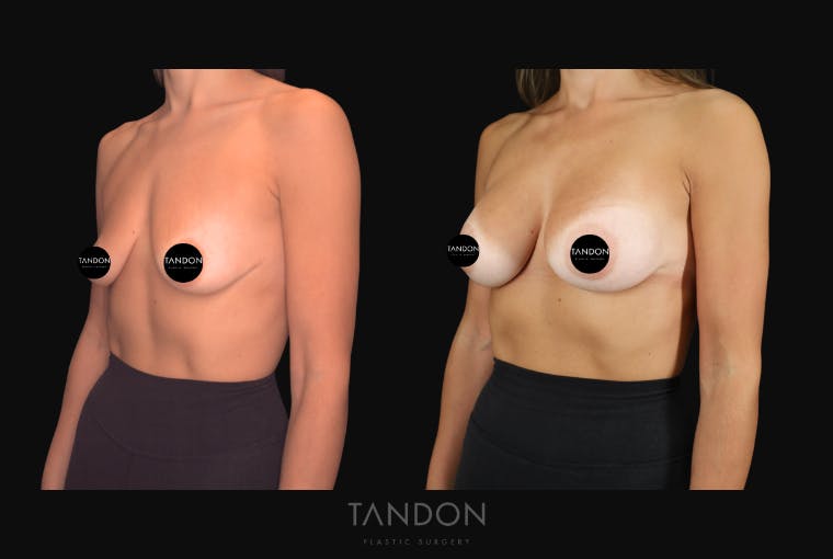 Breast Augmentation Before & After Gallery - Patient 292318 - Image 4