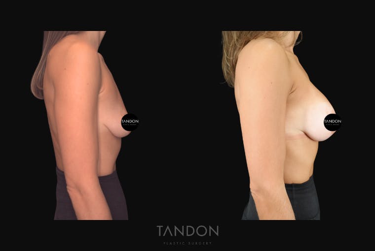 Breast Augmentation Before & After Gallery - Patient 292318 - Image 3