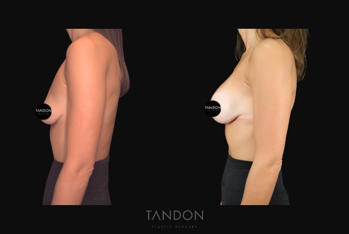 Breast Augmentation  Before & After Gallery - Patient 292318 - Image 5
