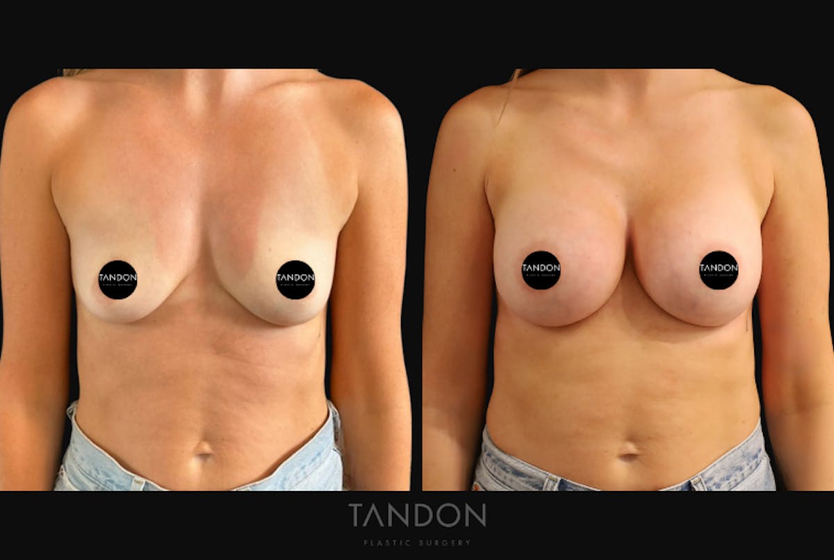 Breast Augmentation  Before & After Gallery - Patient 919895 - Image 1