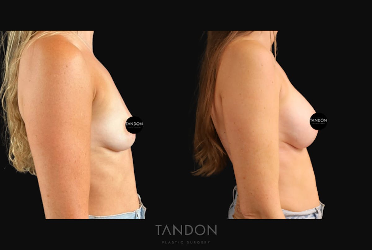 Breast Augmentation  Before & After Gallery - Patient 919895 - Image 3