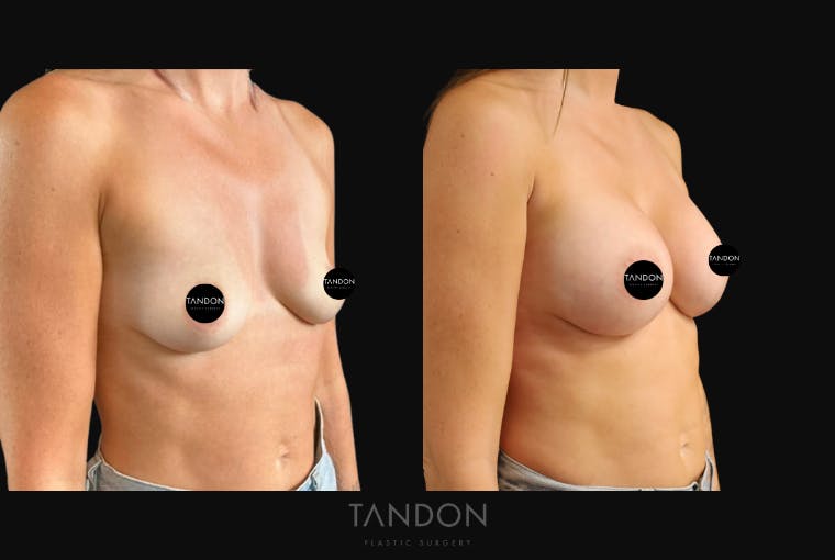 Breast Augmentation Before & After Gallery - Patient 919895 - Image 2