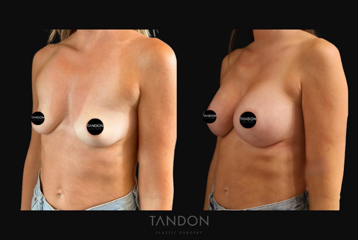Breast Augmentation  Before & After Gallery - Patient 919895 - Image 4