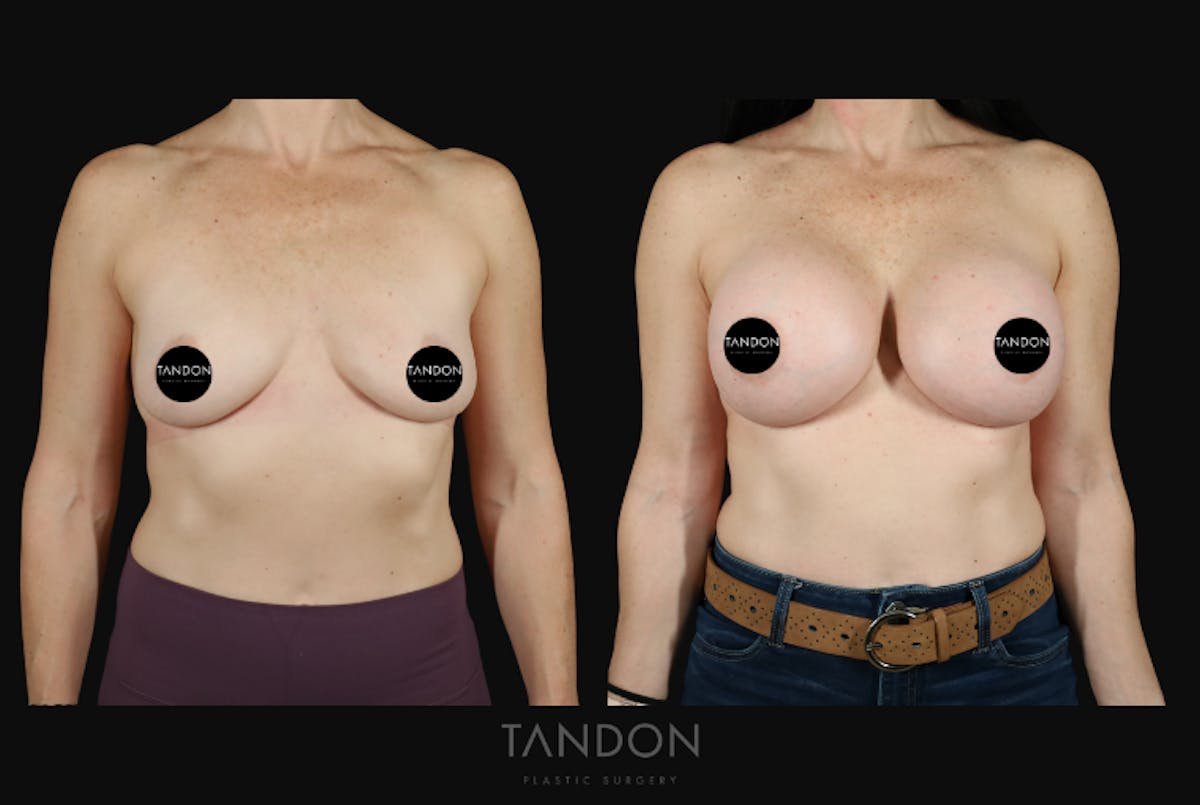 Breast Augmentation  Before & After Gallery - Patient 273643 - Image 1
