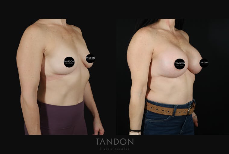 Breast Augmentation Before & After Gallery - Patient 273643 - Image 2