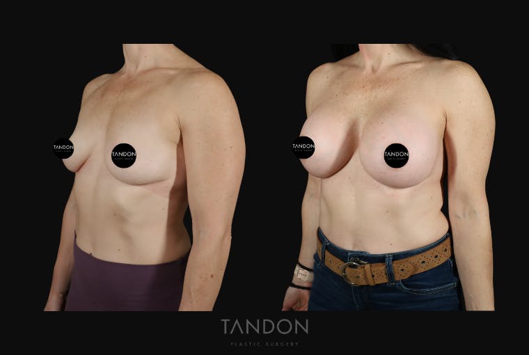 Breast Augmentation Before & After Gallery - Patient 273643 - Image 3