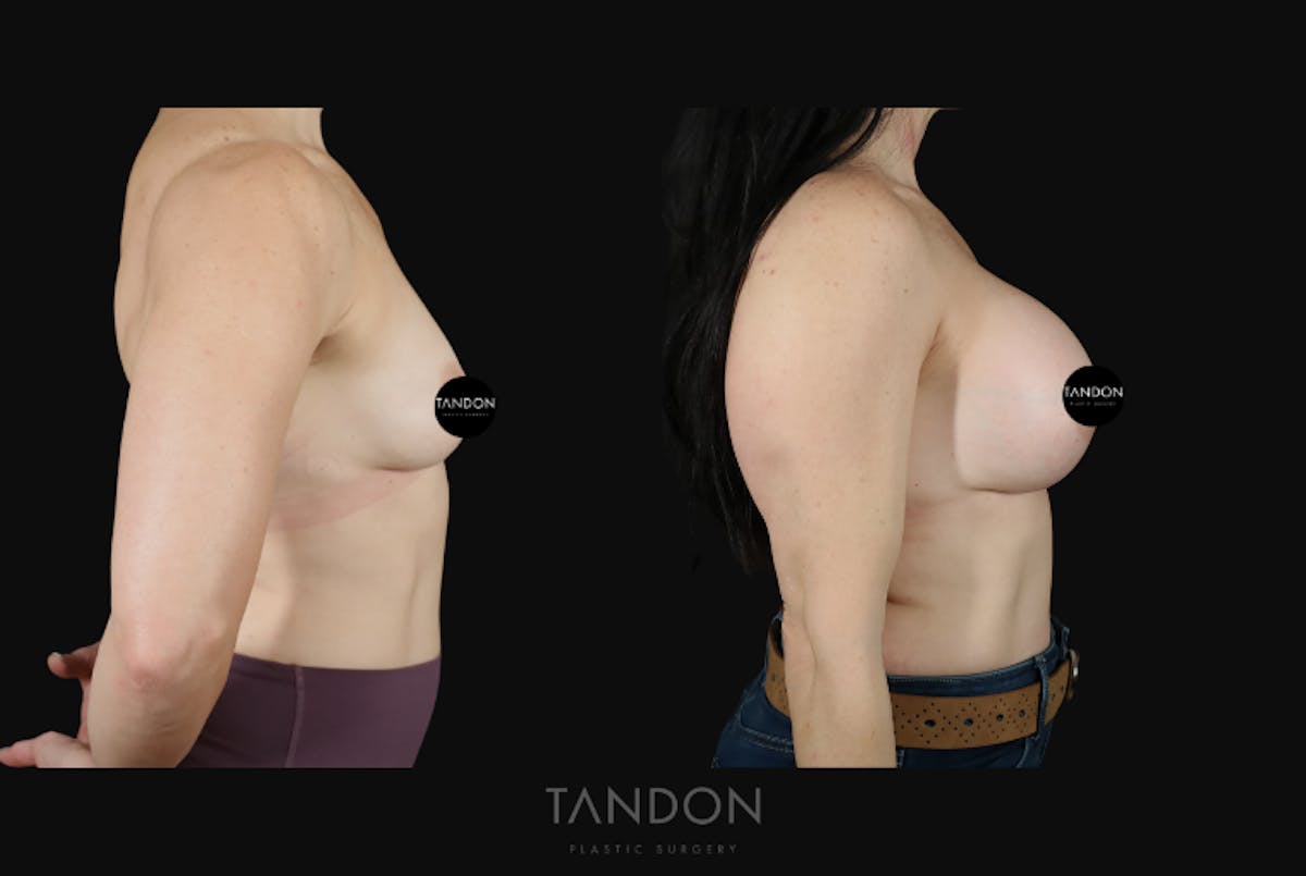 Breast Augmentation  Before & After Gallery - Patient 273643 - Image 4