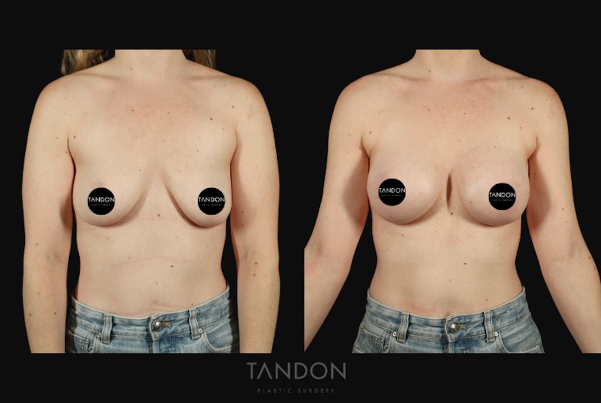 Breast Augmentation  Before & After Gallery - Patient 130926 - Image 1