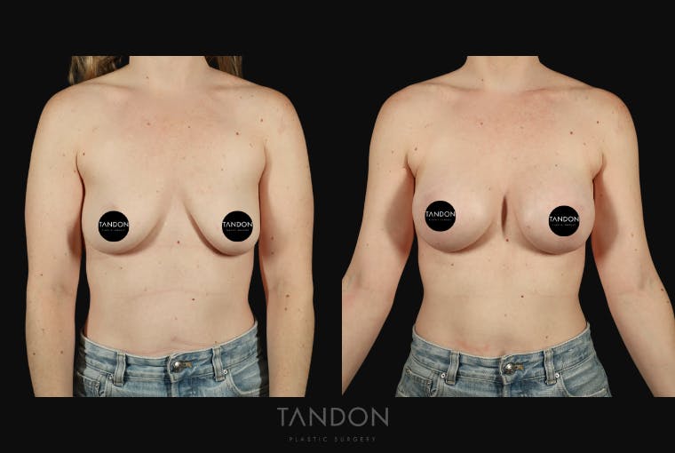 Breast Augmentation Before & After Gallery - Patient 130926 - Image 1