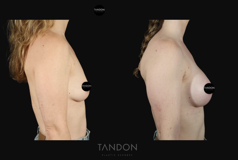 Breast Augmentation Before & After Gallery - Patient 130926 - Image 2