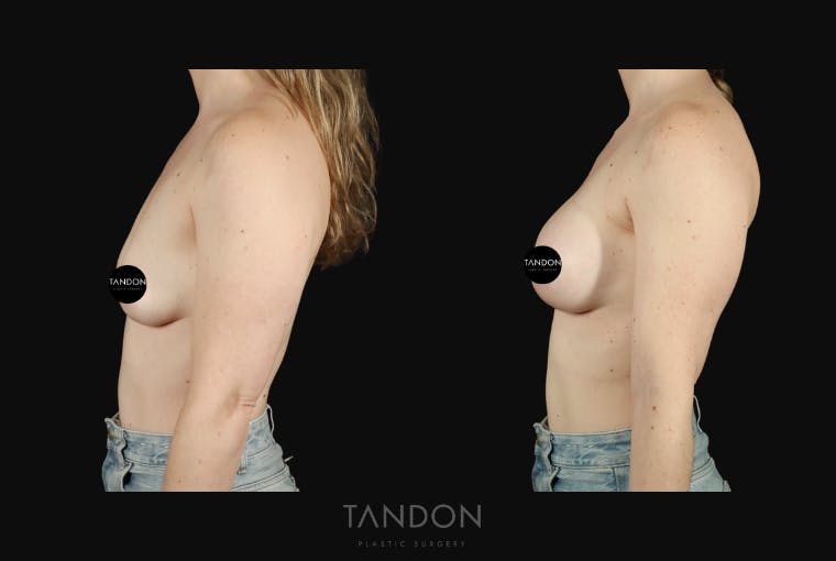 Breast Augmentation Before & After Gallery - Patient 130926 - Image 3