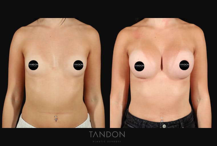 Breast Augmentation Before & After Gallery - Patient 413558 - Image 1