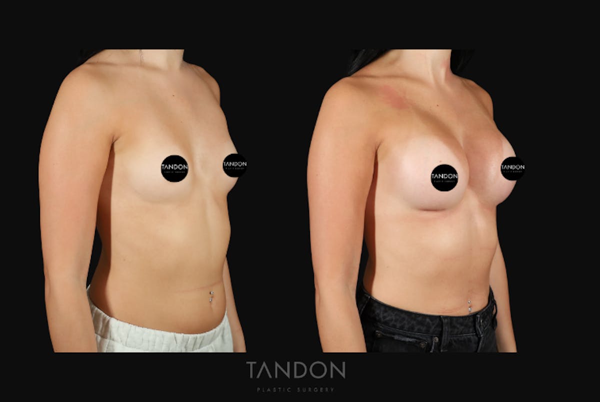 Breast Augmentation  Before & After Gallery - Patient 413558 - Image 2
