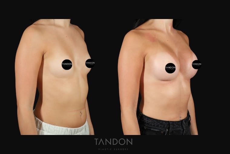 Breast Augmentation Before & After Gallery - Patient 413558 - Image 2