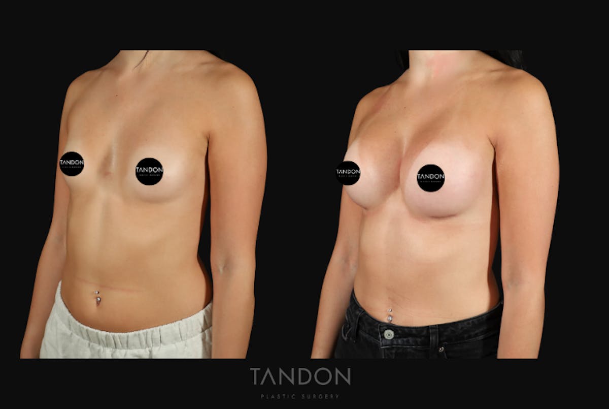 Breast Augmentation  Before & After Gallery - Patient 413558 - Image 3
