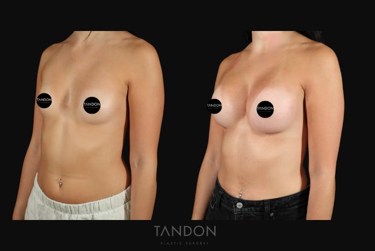 Breast Augmentation Before & After Gallery - Patient 413558 - Image 3