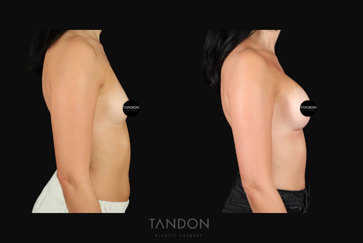 Breast Augmentation  Before & After Gallery - Patient 413558 - Image 4
