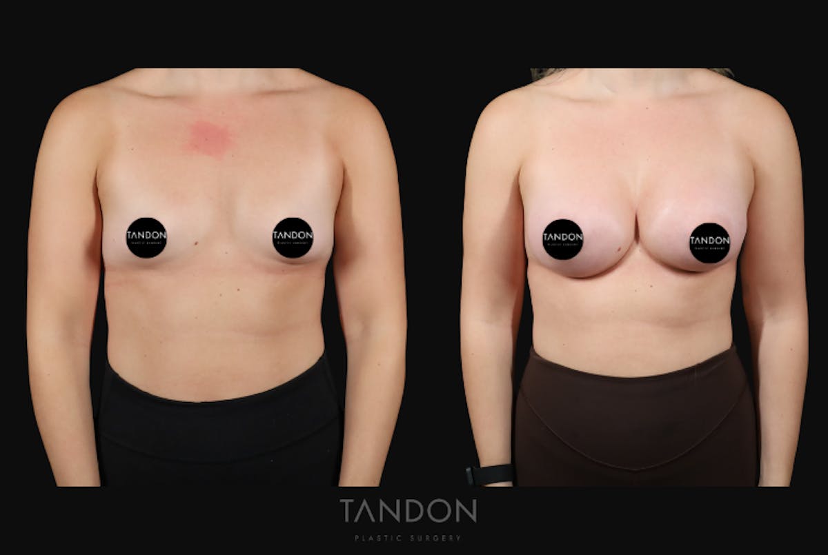 Breast Augmentation  Before & After Gallery - Patient 155525 - Image 1