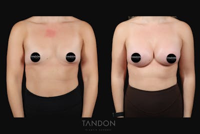 Breast Augmentation Before & After Gallery - Patient 155525 - Image 1