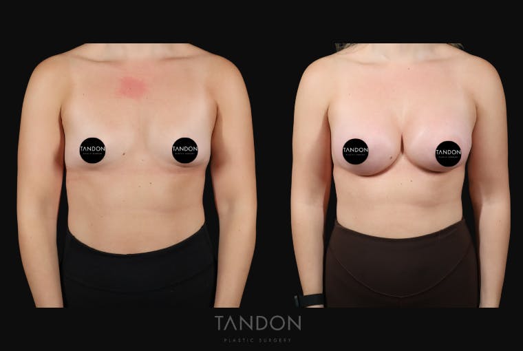 Breast Augmentation Before & After Gallery - Patient 155525 - Image 1