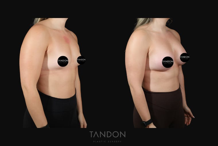 Breast Augmentation Before & After Gallery - Patient 155525 - Image 2