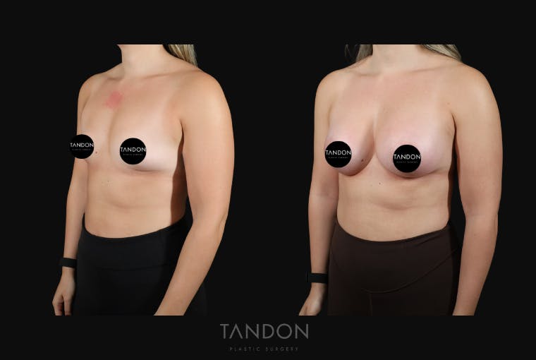 Breast Augmentation Before & After Gallery - Patient 155525 - Image 4