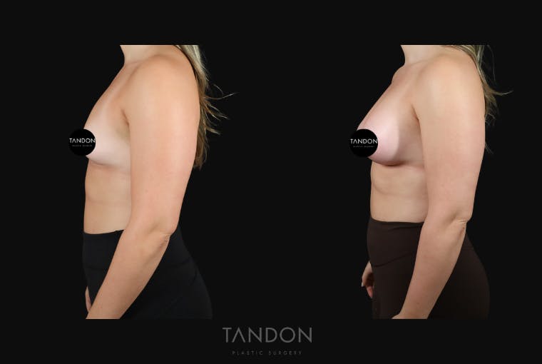 Breast Augmentation Before & After Gallery - Patient 155525 - Image 3
