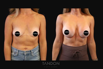 Breast Augmentation Before & After Gallery - Patient 419950 - Image 1