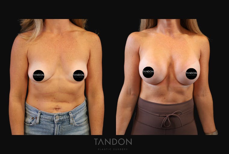 Breast Augmentation Before & After Gallery - Patient 419950 - Image 1