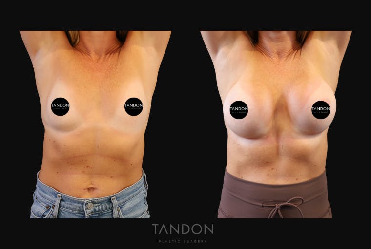 Breast Augmentation Before & After Gallery - Patient 419950 - Image 5