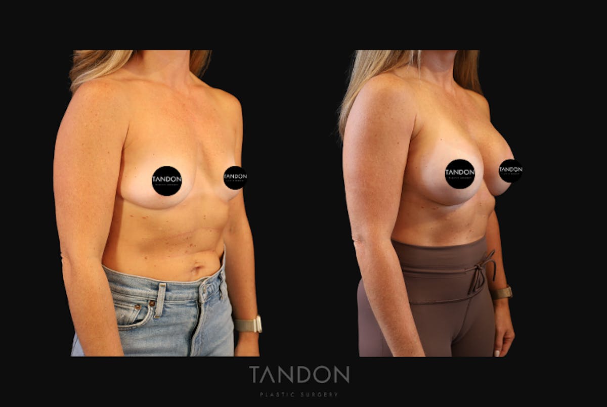 Breast Augmentation  Before & After Gallery - Patient 419950 - Image 2