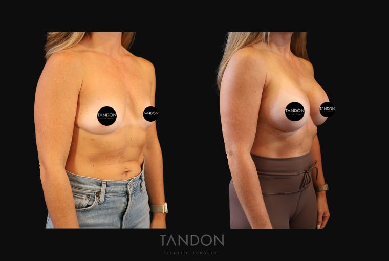 Breast Augmentation Before & After Gallery - Patient 419950 - Image 2