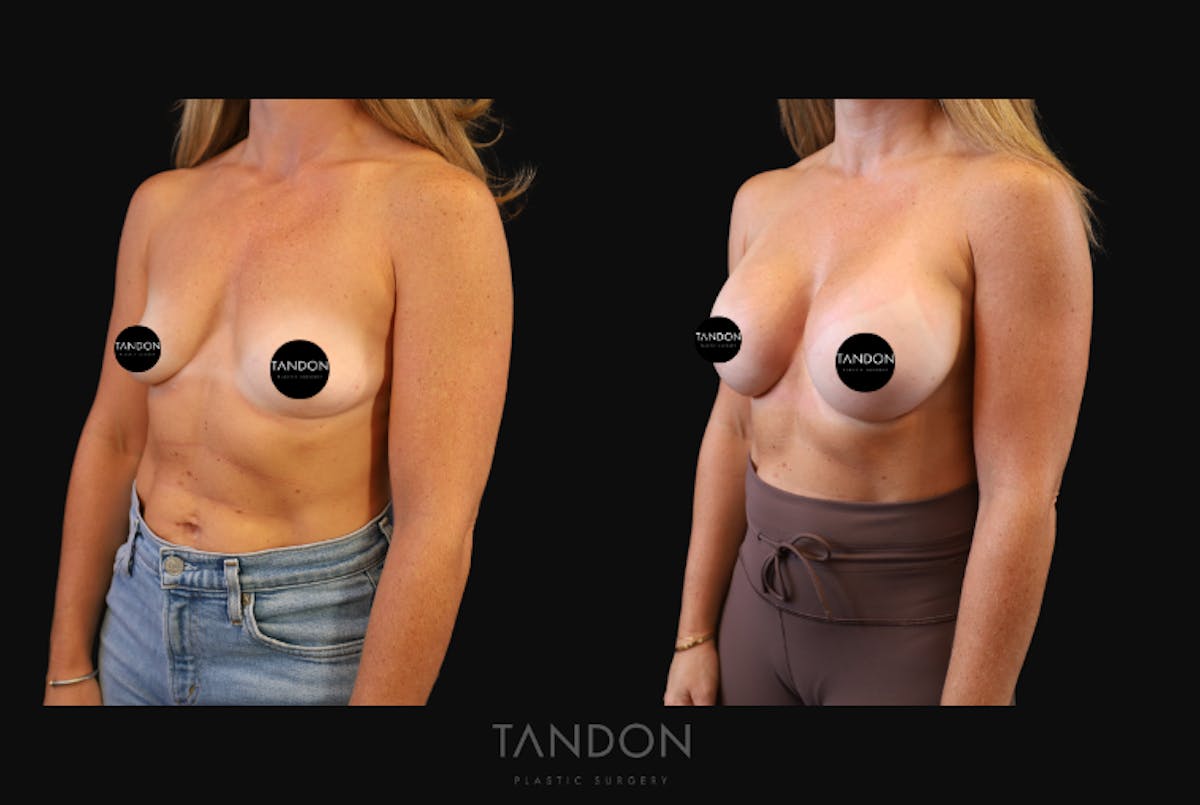 Breast Augmentation  Before & After Gallery - Patient 419950 - Image 6