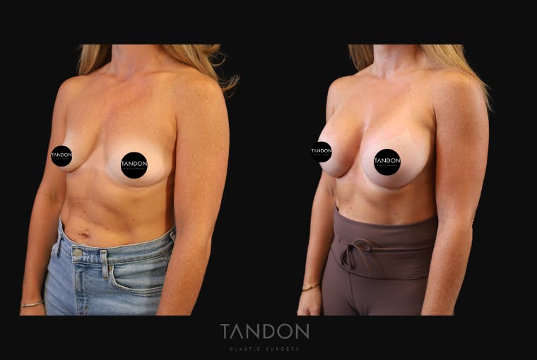 Breast Augmentation Before & After Gallery - Patient 419950 - Image 6