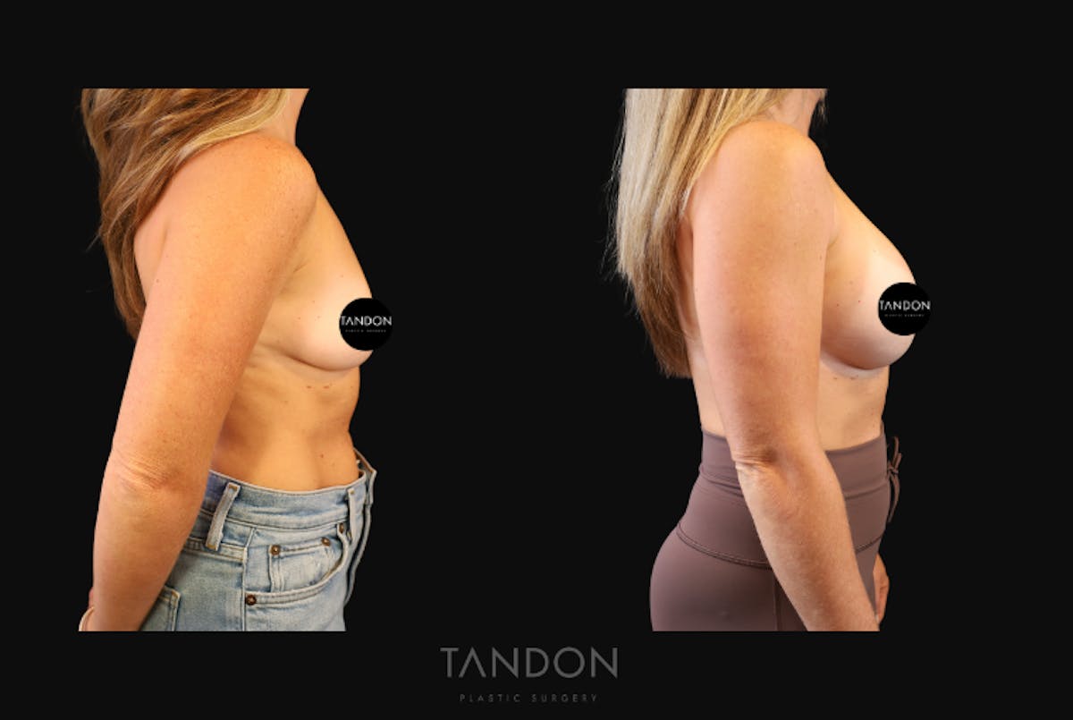 Breast Augmentation  Before & After Gallery - Patient 419950 - Image 3