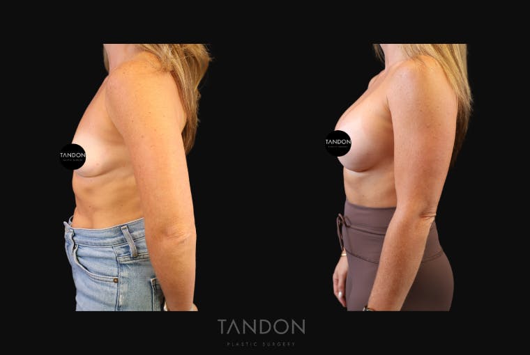 Breast Augmentation Before & After Gallery - Patient 419950 - Image 4
