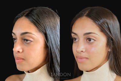 Dermal Fillers Before & After Gallery - Patient 125322 - Image 1