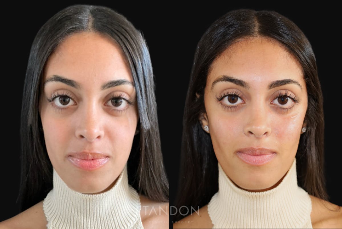 Dermal Fillers Before & After Gallery - Patient 125322 - Image 2