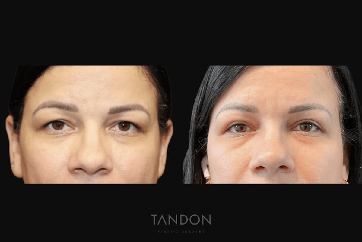 Blepharoplasty Before & After Gallery - Patient 729676 - Image 1