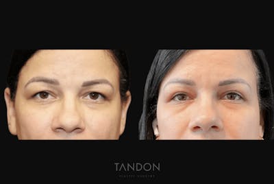 Blepharoplasty Before & After Gallery - Patient 729676 - Image 1